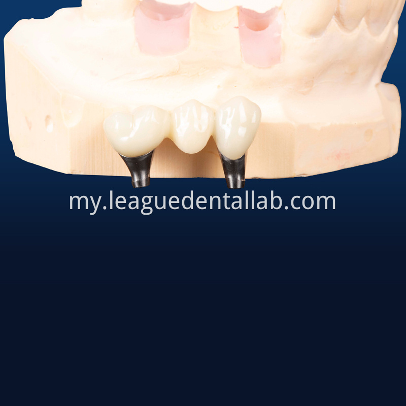 Dental Implant Crown, Dental Implant Zirconia crown,Dental Implant Emax crown,Dental Implant Bridge